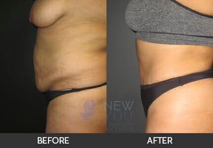 Liposuction vs Tummy Tuck - Chicago Liposuction by Lift Body Center
