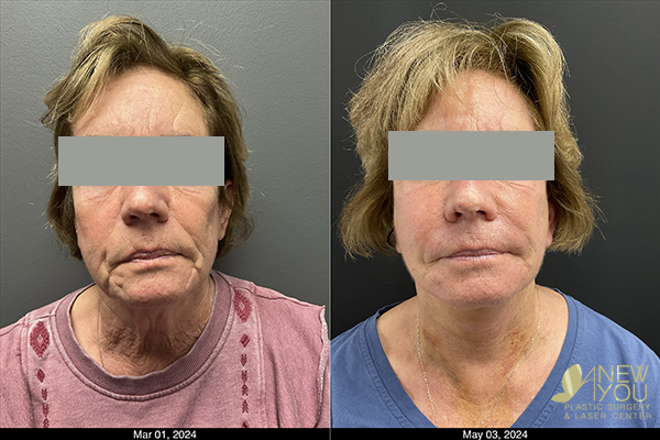 Fall: The Perfect Time For A Chemical Peel - Before and After Results