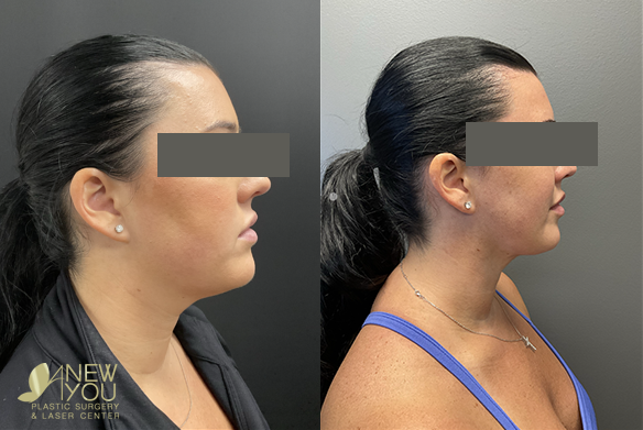 The Benefits Of Chin And Neck Liposuction