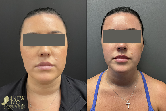 Chin And Neck Liposuction Before and After2