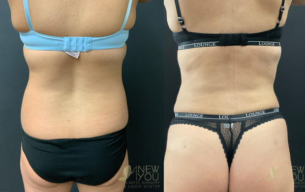 Understanding Body Contouring and Sculpting Your Ideal Shape