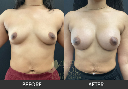 Breast Augmentation Gallery