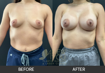 Breast Augmentation Gallery