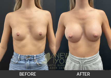 Breast Augmentation Gallery