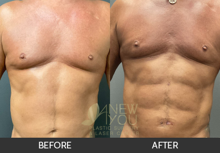 Male Liposuction Gallery