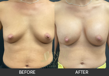 Breast Augmentation Gallery