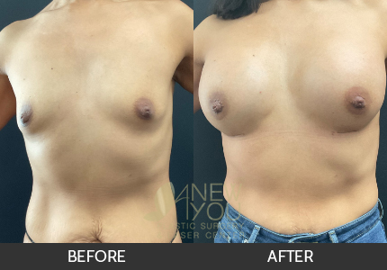 Breast Augmentation Gallery