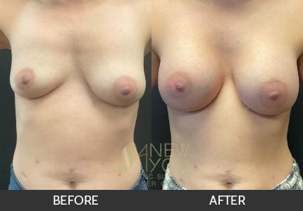 Breast Augmentation Gallery