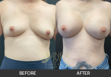 Breast Augmentation Gallery