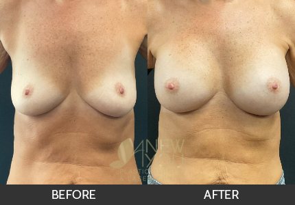 Breast Augmentation Gallery