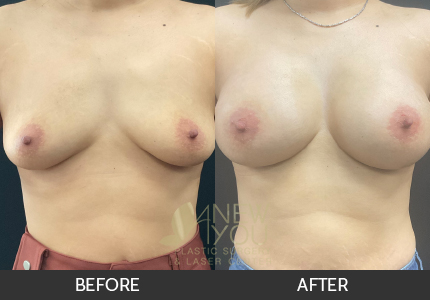 Breast Augmentation Gallery