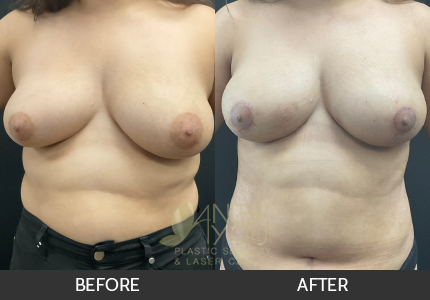 Breast Lift Gallery